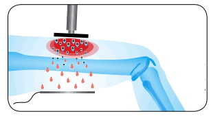 TECARTERAPIA CAPACITIVA